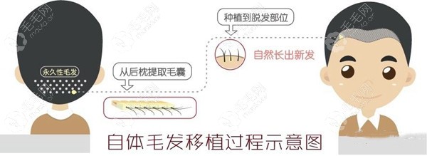 植发3000毛囊和3500单位的对比图看差500毛囊差多大面积