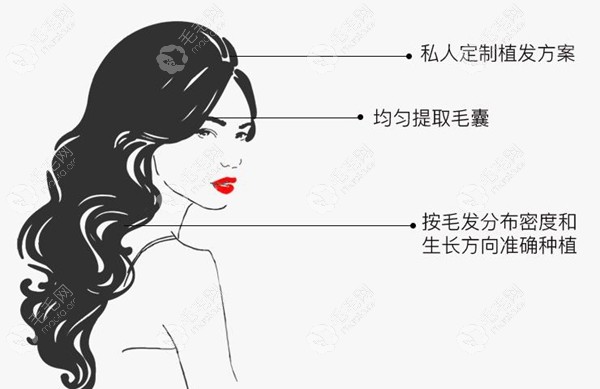 深圳女性植发多少钱