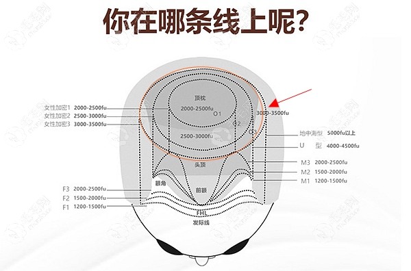植发3000毛囊和3500单位的对比图看差500毛囊差多大面积