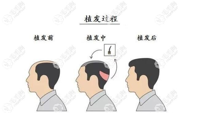 植发的简单流程
