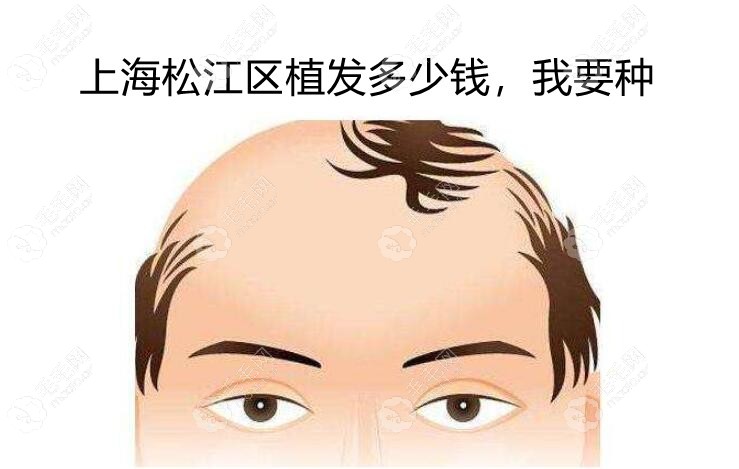 在上海松江植发一般要多少钱?按1个毛囊单位计算价格在...