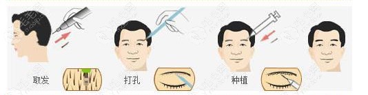 眉毛种植的手术过程