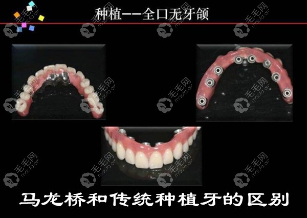 马龙桥和传统种植牙的区别除了流程还有优缺点哦 - 口腔健康 - 毛毛网