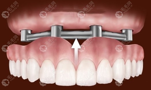 70岁老人全口假牙价目表这有镶哪种牙实惠耐用也有提到