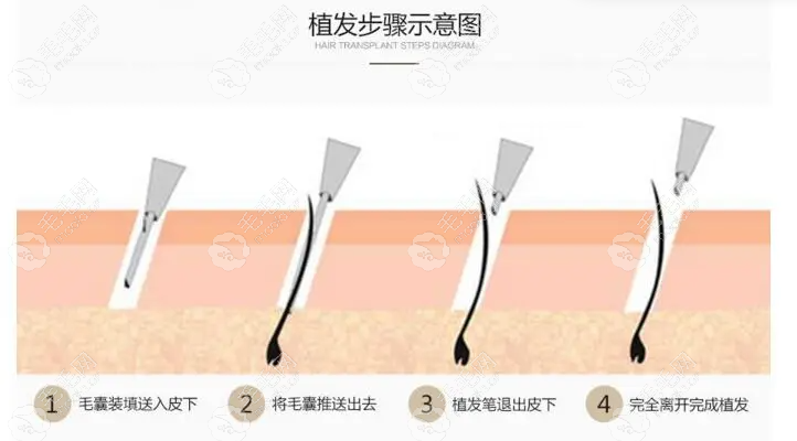 植发原理图图片