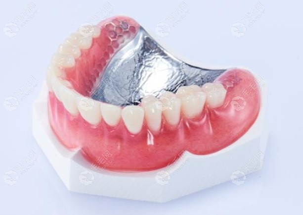  纯钛基托活动义齿