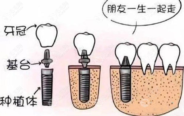 马龙桥和传统种植牙的区别除了流程还有优缺点哦 - 口腔健康 - 毛毛网