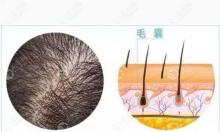 植发后如何判断毛囊是否存活,被移植过的毛囊还会长头发吗