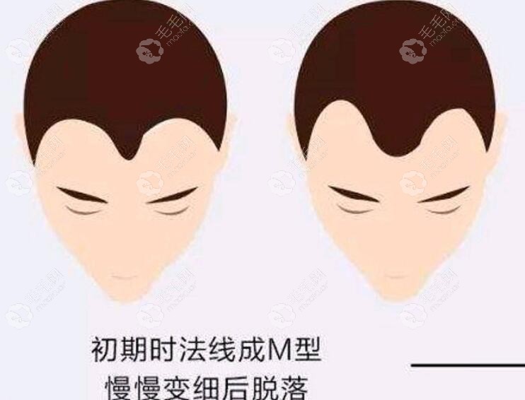 初期m发际线的症状