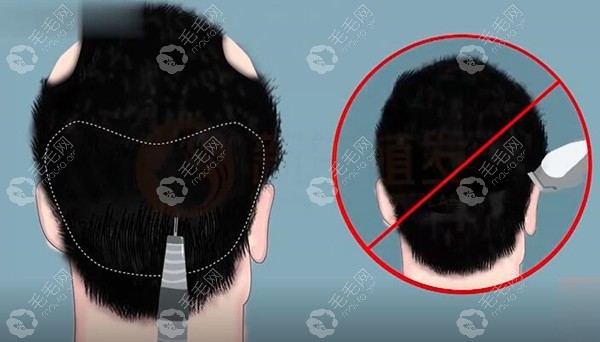 不剃发技术单次一般提取2000单位以内,适合哪种脱发类型？