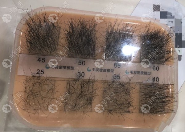 地中海植发一般需要多少毛囊?植20平方厘米不等于植4000单位