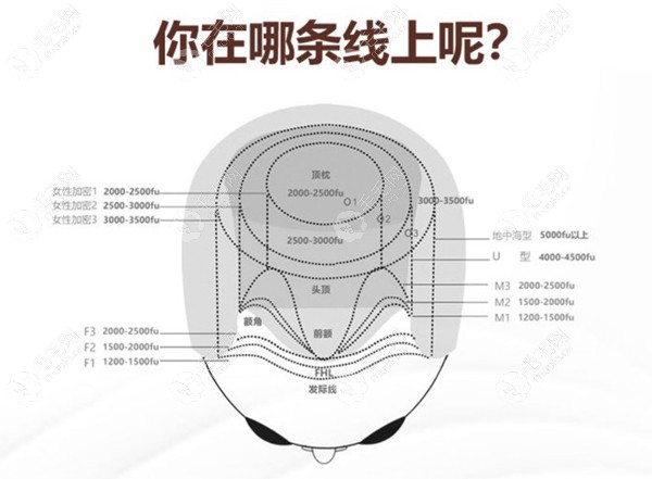 北京发际线1cm植发一般多少钱,想在海淀区用NHT治发际线后移