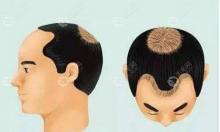 男性4级脱发植发需要多少毛囊,还在脱发时植发可以阻止吗?