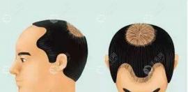 男性4级脱发植发需要多少毛囊,还在脱发时植发可以阻止吗?
