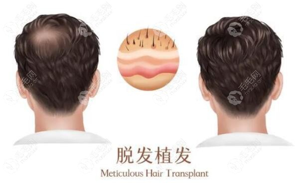 植发是多少单位(植发最低多少单位)