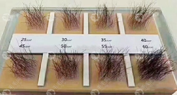 每平方厘米种植40~60个毛囊单位的密度图