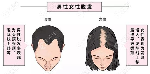 男女脱发的形式不一样