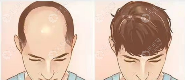 脱发类型不同植发方式不同