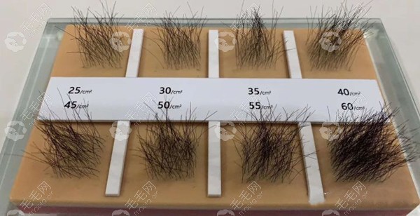 植发每平方厘米不同密度的呈现结果