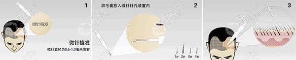微针植发技术操作过程