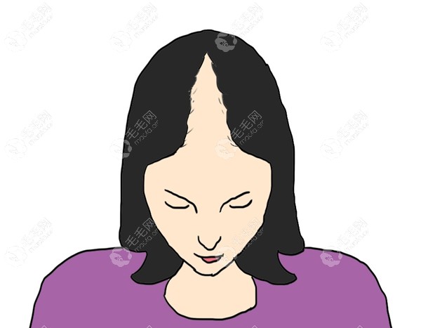 这就是女性头顶圣诞树状脱发