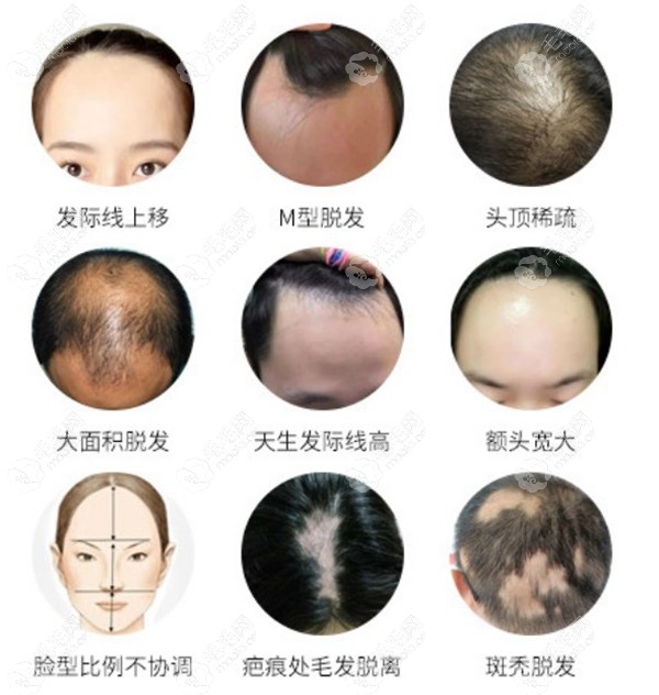 新疆乌鲁木齐植发一个毛囊价格列出fue微针不剃发植发价