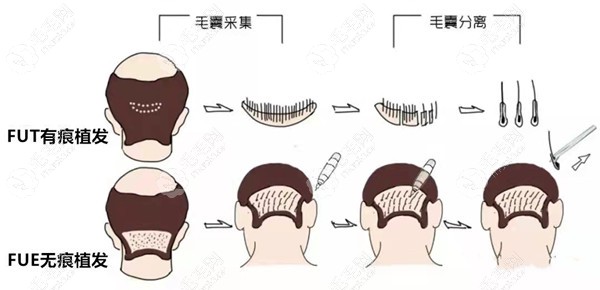 FUT隐痕植发技术（切开式植发）和FUE无痕植发技术（非切开式植发）的区别