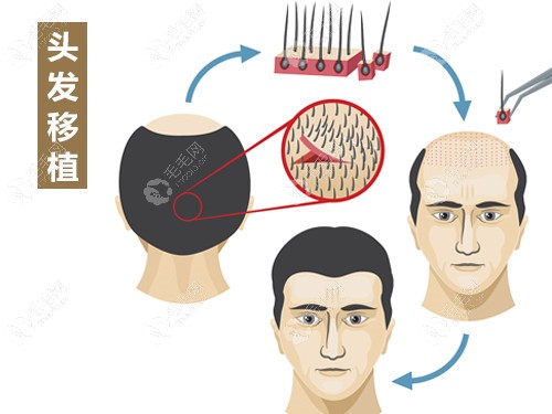头发种植手术过程