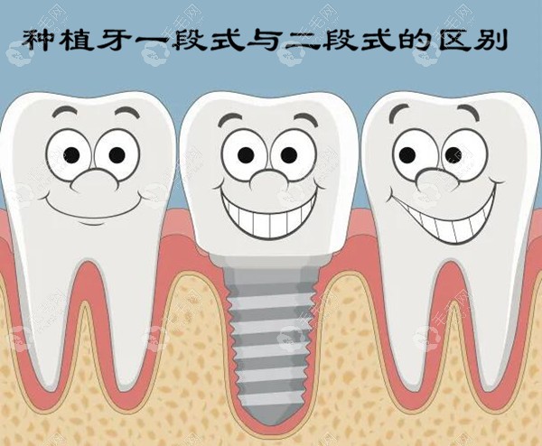 种植牙一段式与二段式的区别