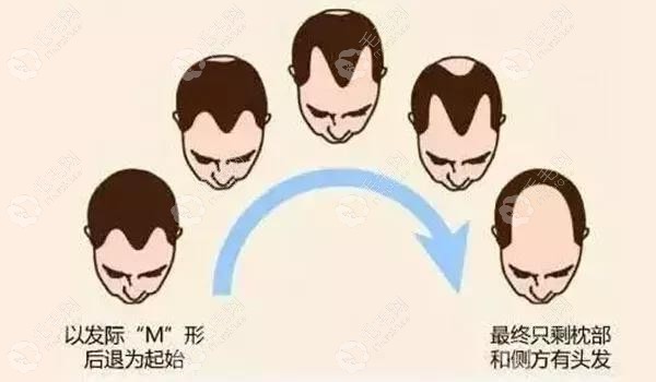 脂溢性/雄性脱发什么时候植发合适?还有斑秃和疤痕性脱发