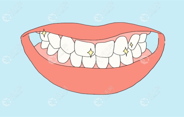 正畸也是修复牙齿稀疏的优选