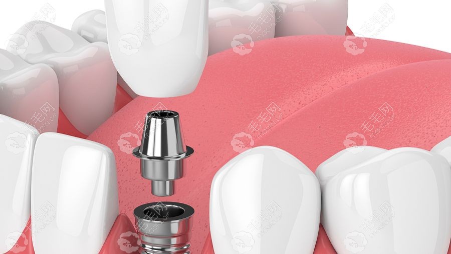 已有新技术替代种牙?基因再生牙/无种植仿生牙是镶牙新方法