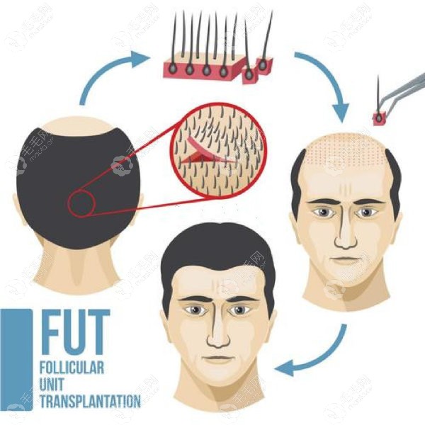 隐痕的FUT植发技术图解