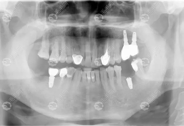 种下第4颗牙后的CT图