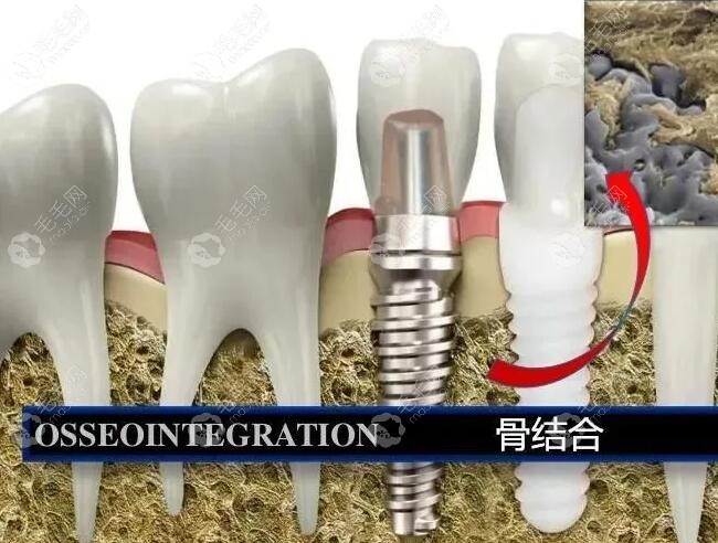 种植牙与牙槽骨的骨结合模拟图
