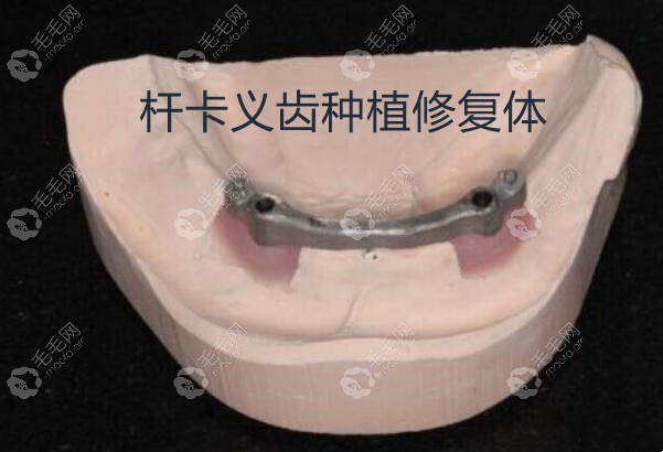 杆卡义齿种植修复体适应症