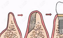 牙龈萎缩厉害也可以种植牙齿,但需先做牙周骨增量(植骨)术