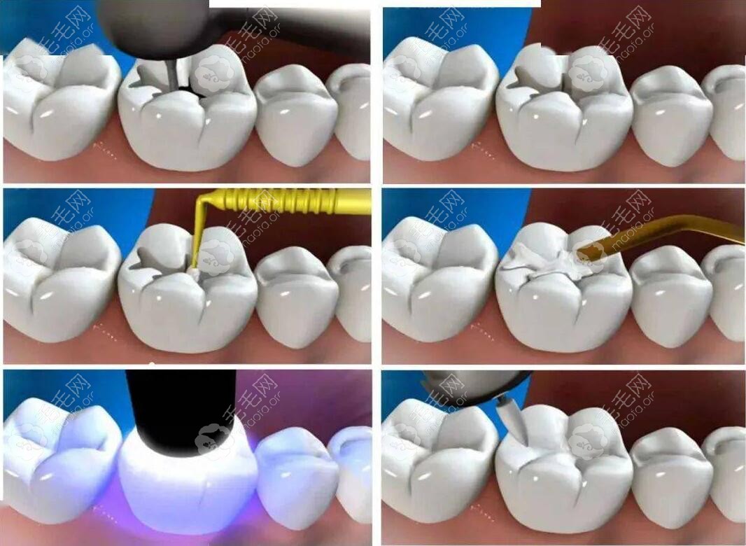 树脂补牙全过程