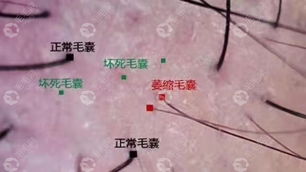 从脱发毛囊萎缩到闭合要多久教你如何判断毛囊是否闭合