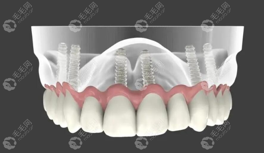 ALL-ON-6种植牙修复