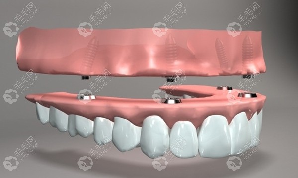 ALL-ON-4种植义齿