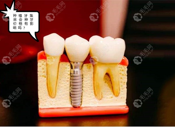 种植牙集采会对种牙价格有影响吗