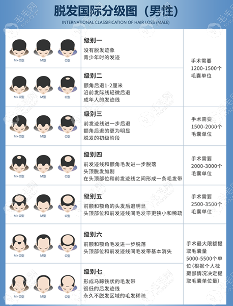 做轻微m型发际线植发多少钱,可从植发形状上了解 - 脱发知识 - 毛毛网