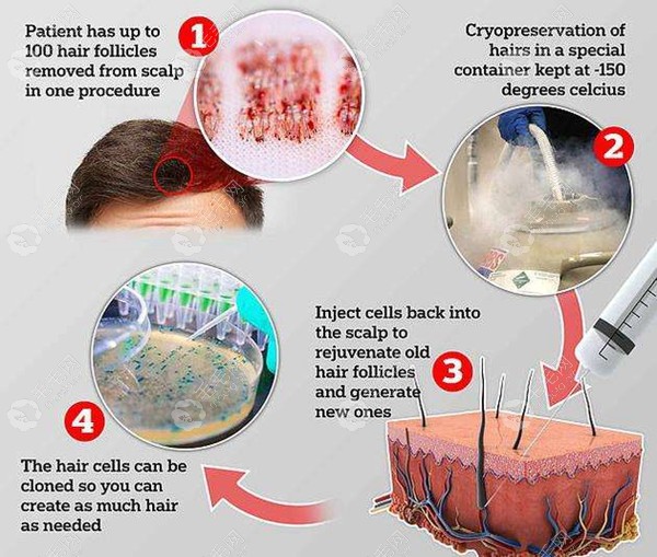 毛囊克隆植发技术的原理