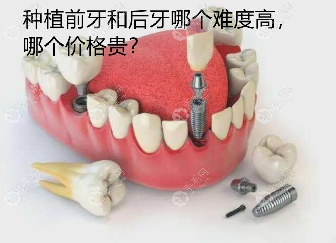 解答:分别种植门牙和大牙的难度和价格是否一样