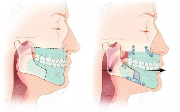 双颌手术过程模拟