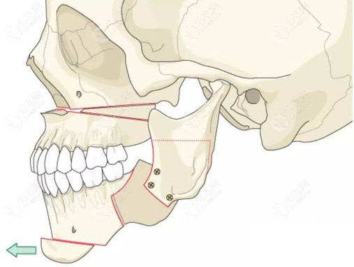 正颌手术+颏成型术