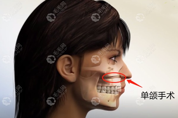 大致来说,成人骨性龅牙做正颌手术一般需要4-15万元钱