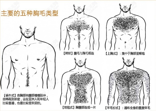 男性胸毛种植类型