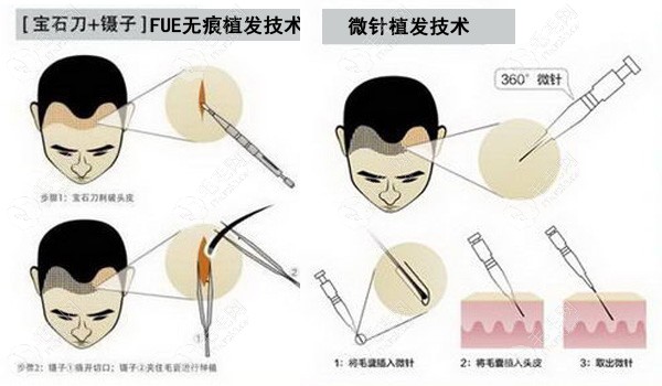 FUE无痕植发技术微针植发技术手术过程